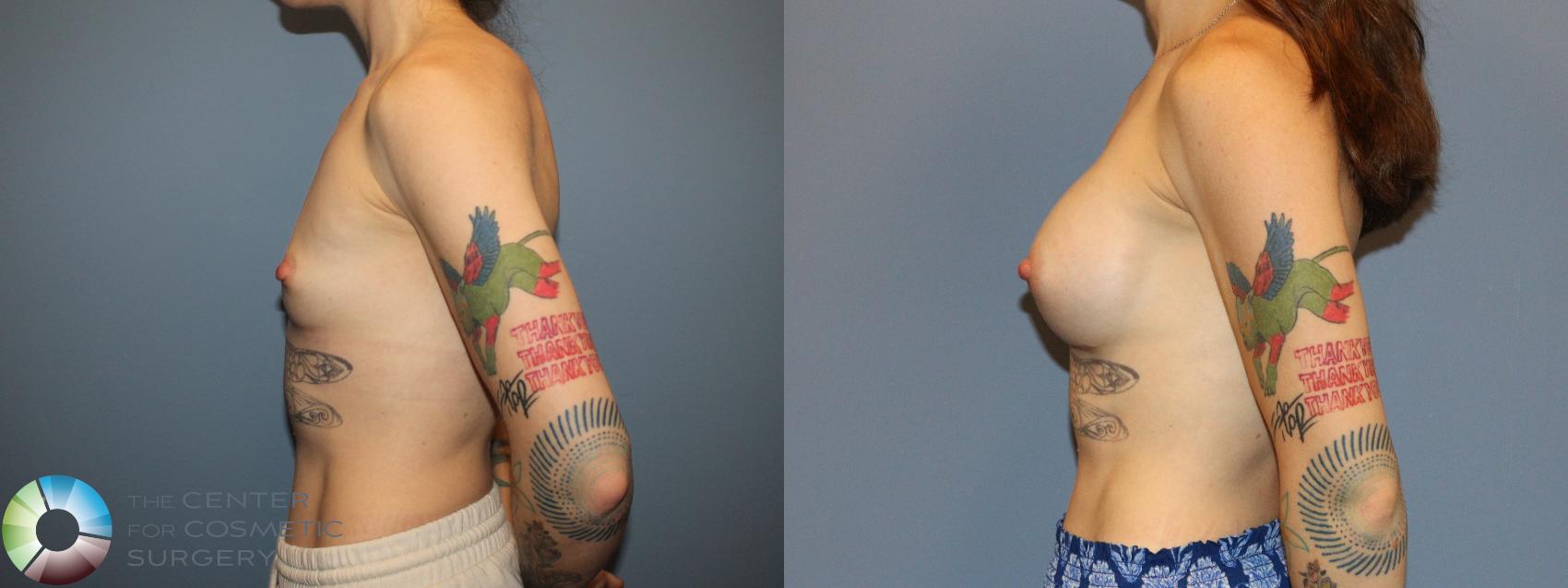 Before & After Breast Augmentation Case 12172 Left Side in Denver and Colorado Springs, CO