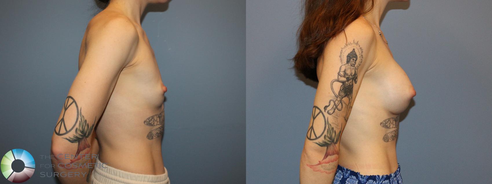 Before & After Breast Augmentation Case 12172 Right Side in Denver and Colorado Springs, CO
