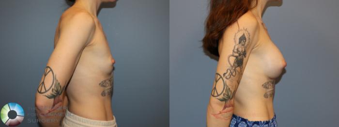 Before & After Motiva Implants® Case 12172 Right Side in Denver and Colorado Springs, CO