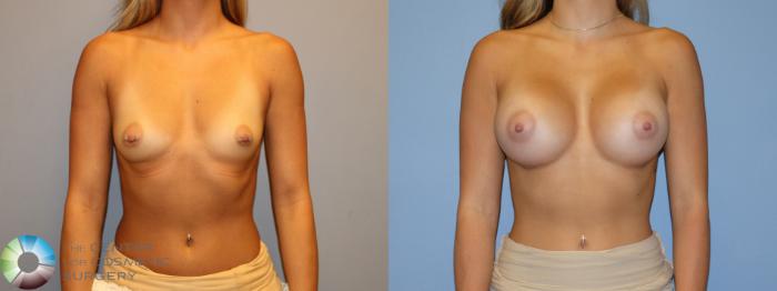 Before & After Motiva Implants® Case 12174 Front in Denver and Colorado Springs, CO