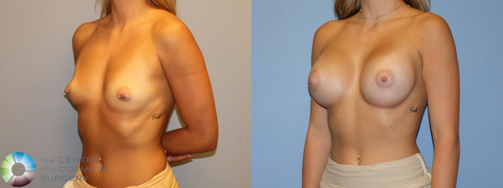 Before & After Breast Augmentation Case 12174 Left Oblique in Denver and Colorado Springs, CO
