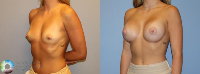 Before & After Motiva Implants® Case 12174 Left Oblique in Denver and Colorado Springs, CO