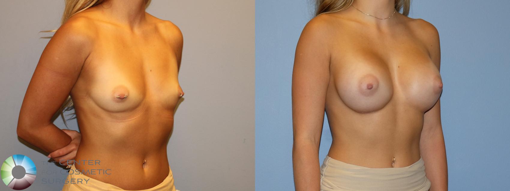 Before & After Breast Augmentation Case 12174 Right Oblique in Denver and Colorado Springs, CO