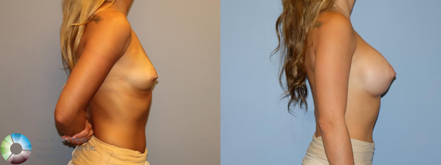 Before & After Breast Augmentation Case 12174 Right Side in Denver and Colorado Springs, CO