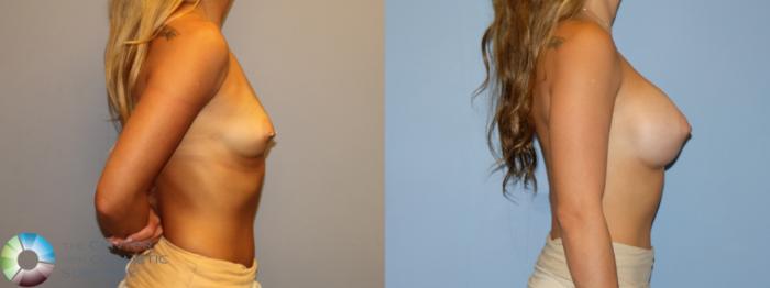 Before & After Motiva Implants® Case 12174 Right Side in Denver and Colorado Springs, CO