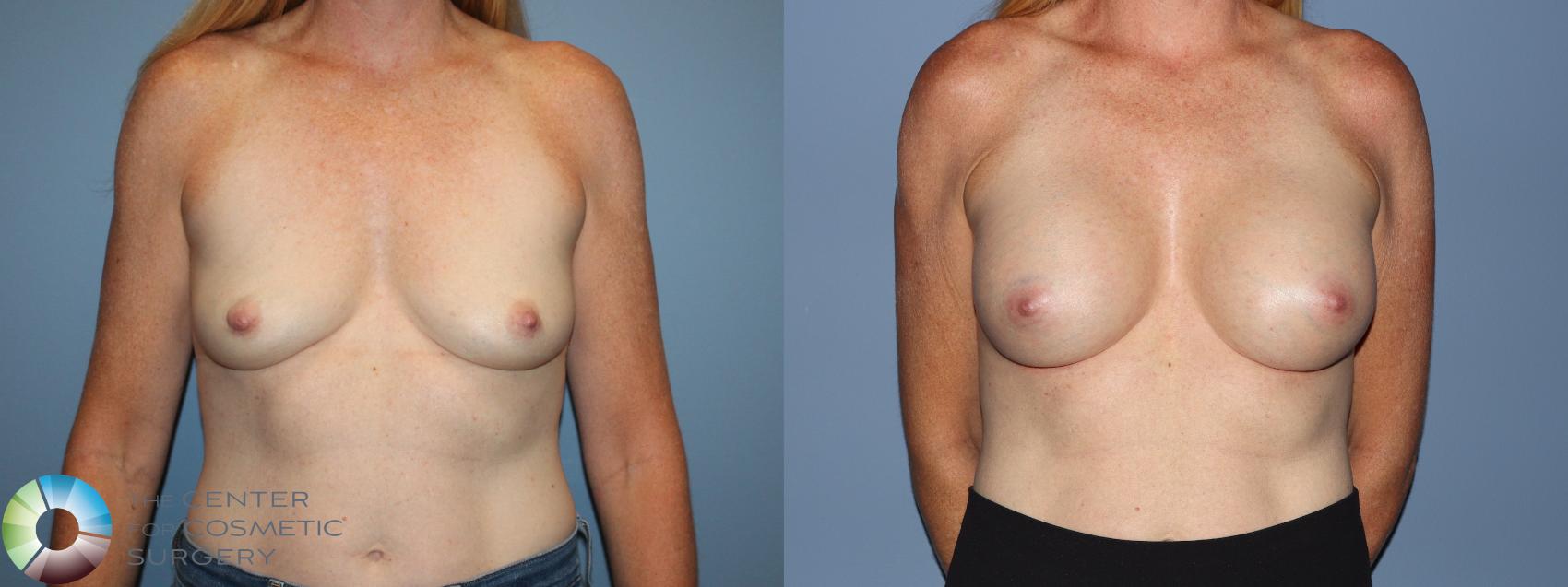 Before & After Breast Augmentation Case 12184 Front in Denver and Colorado Springs, CO