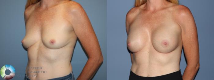 Before & After Breast Augmentation Case 12184 Left Oblique in Denver and Colorado Springs, CO