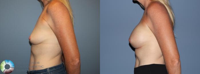 Before & After Breast Augmentation Case 12184 Left Side in Denver and Colorado Springs, CO