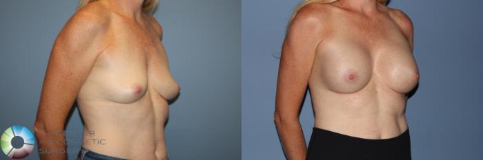 Before & After Breast Augmentation Case 12184 Right Oblique in Denver and Colorado Springs, CO