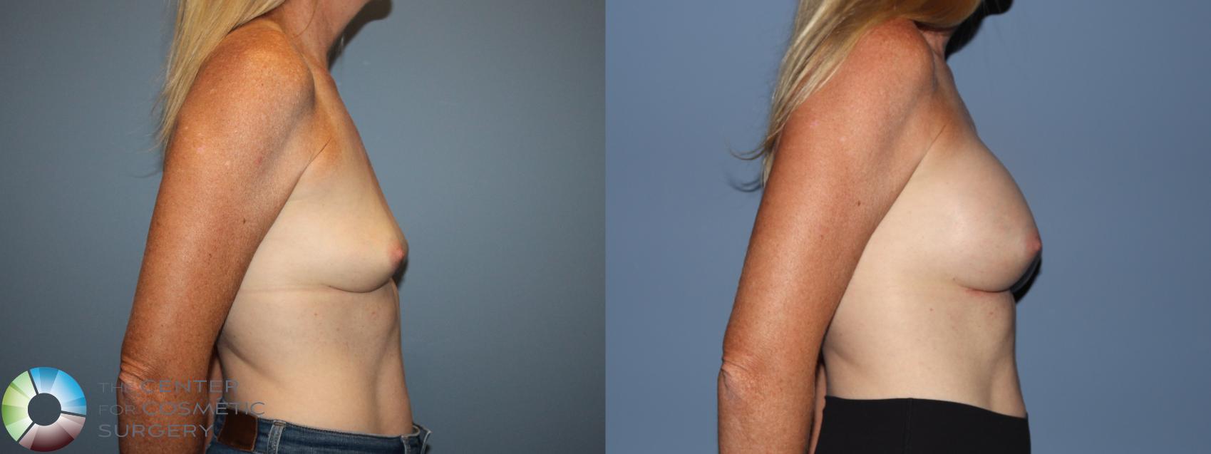 Before & After Breast Augmentation Case 12184 Right Side in Denver and Colorado Springs, CO