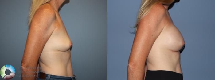 Before & After Breast Augmentation Case 12184 Right Side in Denver and Colorado Springs, CO