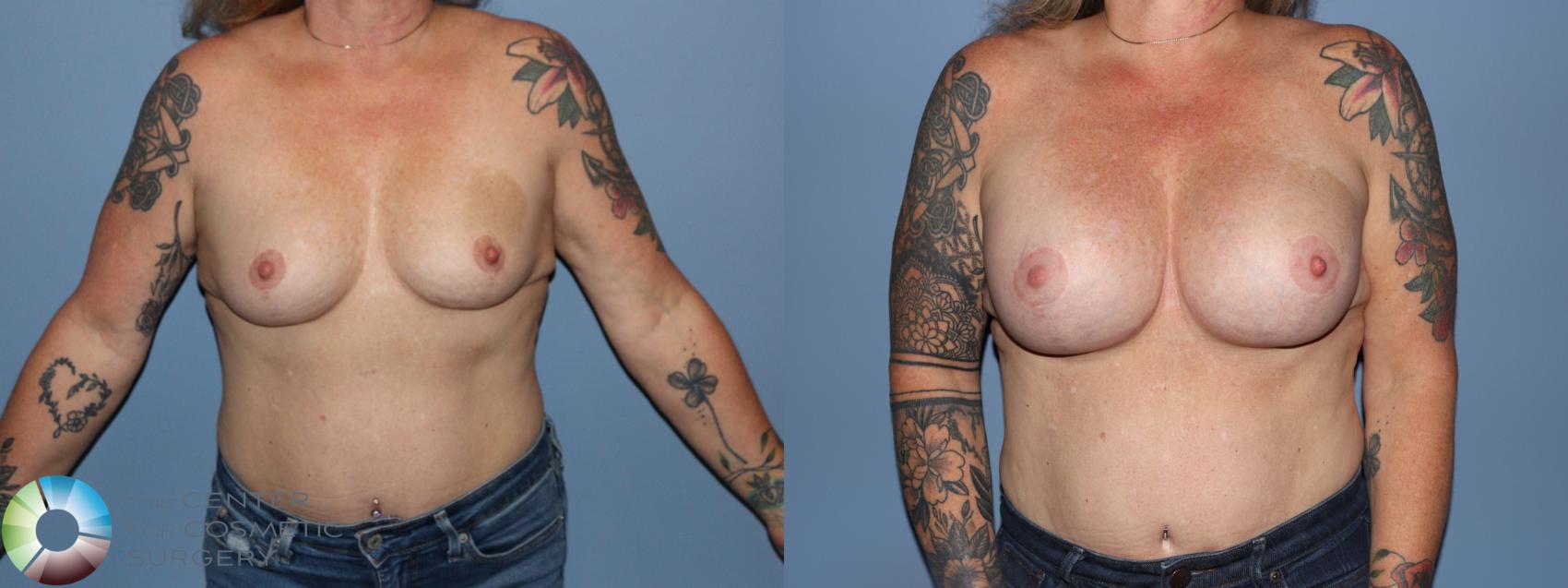 Before & After Motiva Implants® Case 12187 Front in Denver and Colorado Springs, CO