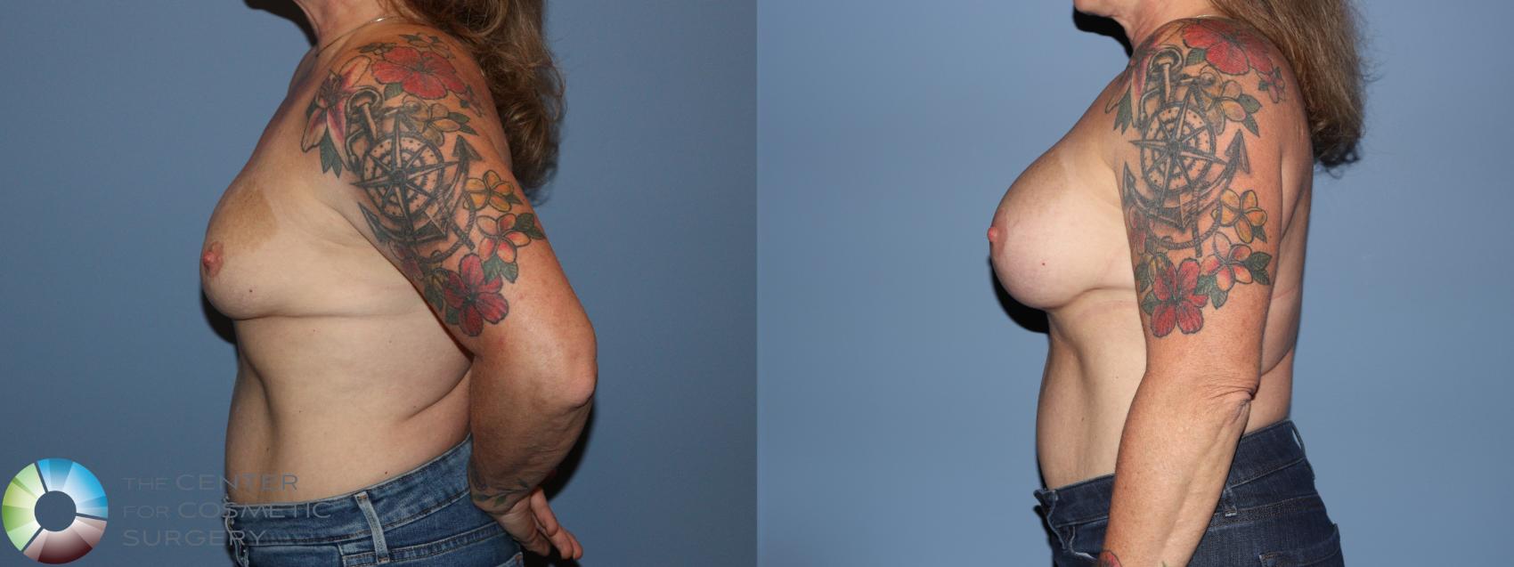 Before & After Breast Augmentation Case 12187 Left Side in Denver and Colorado Springs, CO
