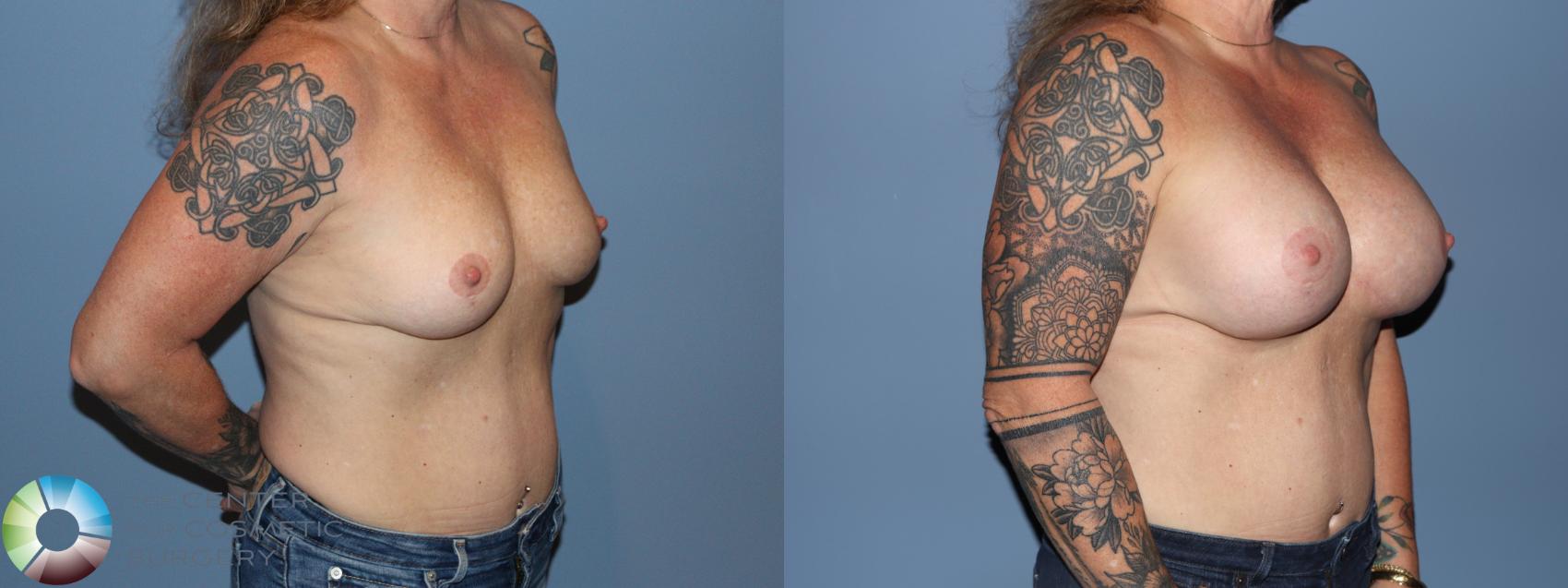 Before & After Breast Augmentation Case 12187 Right Oblique in Denver and Colorado Springs, CO