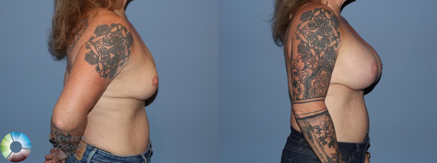 Before & After Breast Augmentation Case 12187 Right Side in Denver and Colorado Springs, CO