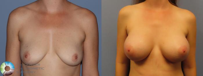 Best Denver Breast Augmentation/Implants Motiva