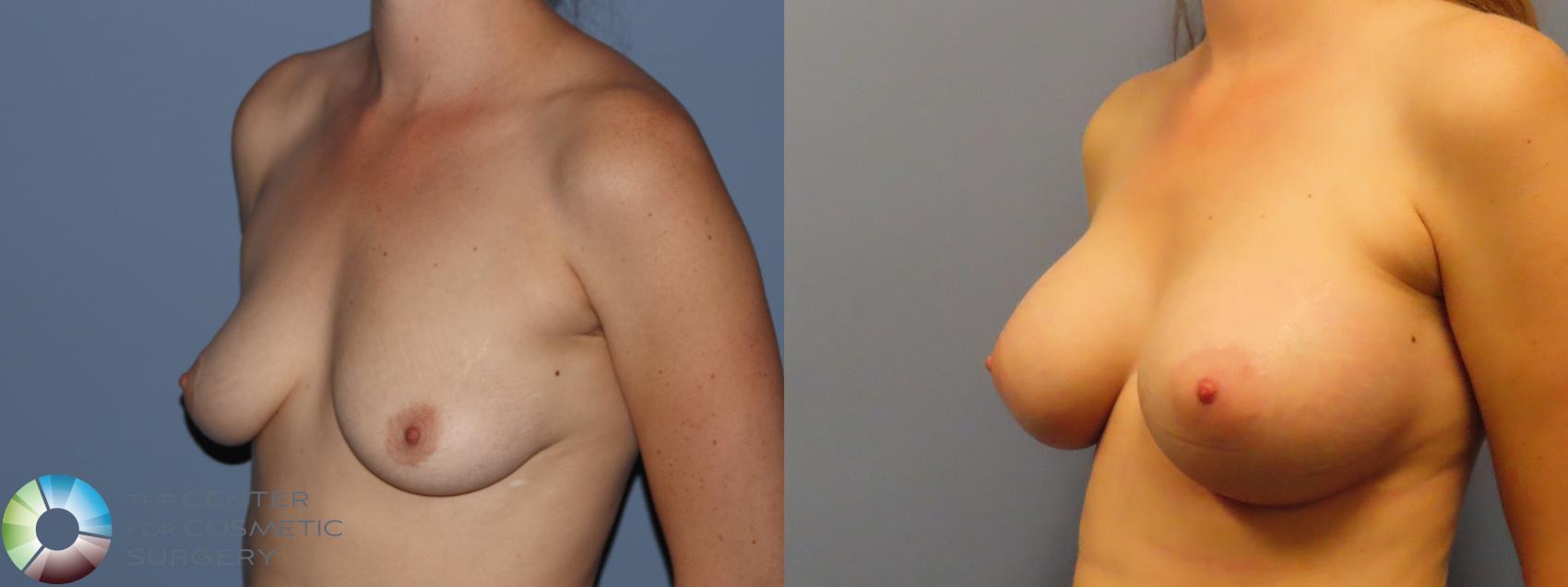 Before & After Breast Augmentation Case 12196 Left Oblique in Denver and Colorado Springs, CO