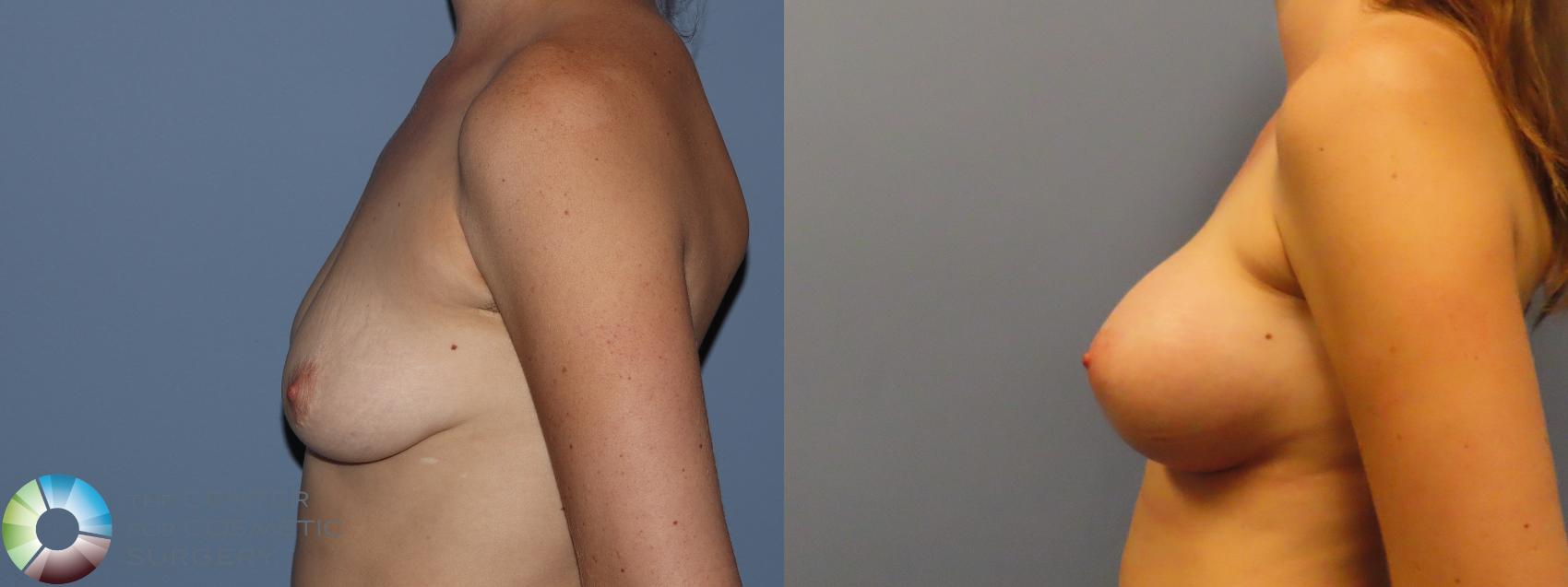 Before & After Breast Augmentation Case 12196 Left Side in Denver and Colorado Springs, CO