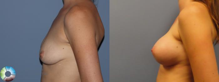 Best Denver Breast Augmentation/Implants Motiva