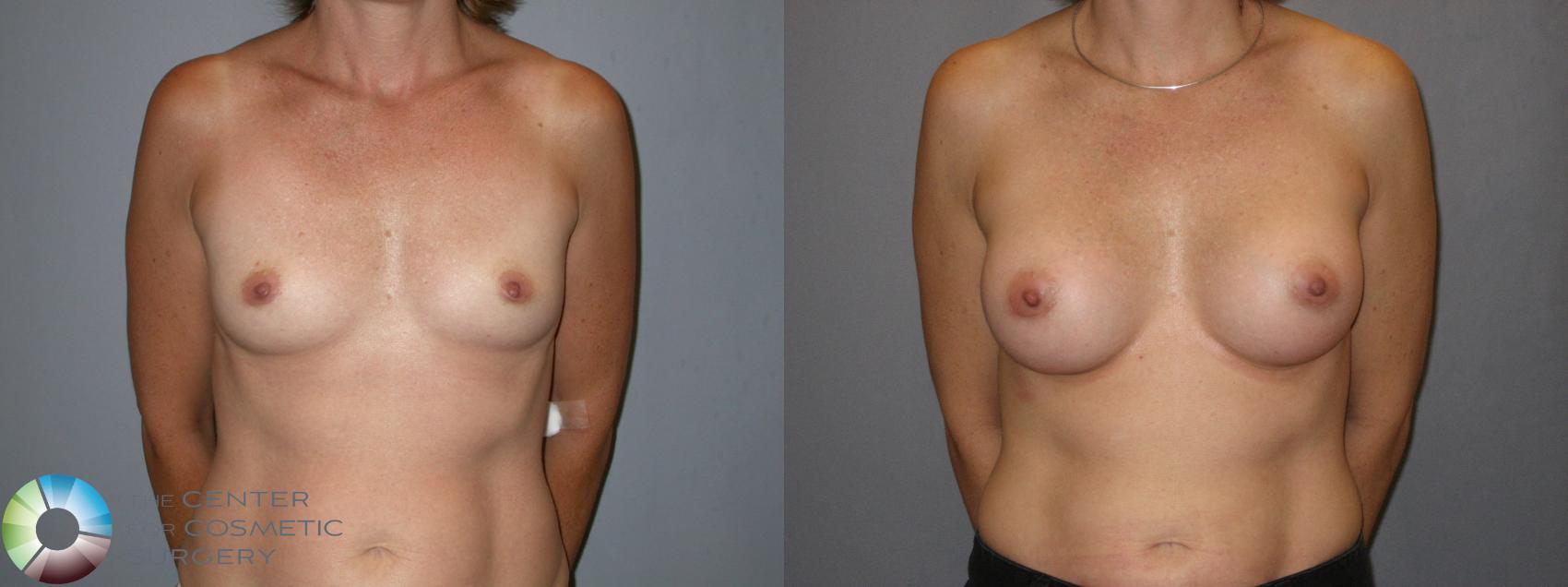 Before & After Breast Augmentation Case 122 View #1 in Denver and Colorado Springs, CO