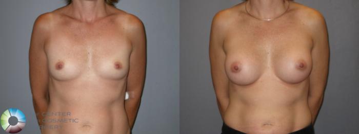 Before & After Breast Augmentation Case 122 View #1 in Denver, CO