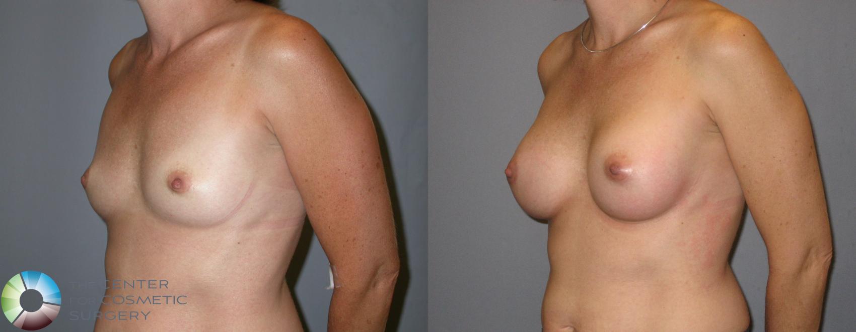 Before & After Breast Augmentation Case 122 View #2 View in Denver & Golden, CO