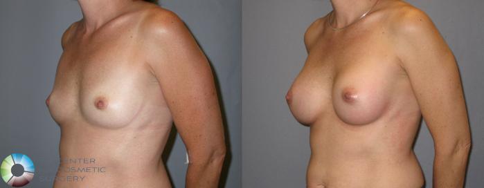 Before & After Breast Augmentation Case 122 View #2 in Denver and Colorado Springs, CO