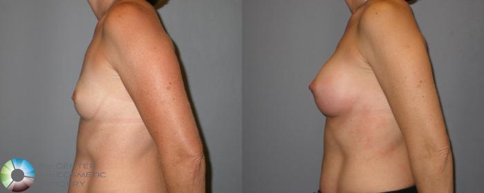Before & After Breast Augmentation Case 122 View #3 in Denver and Colorado Springs, CO