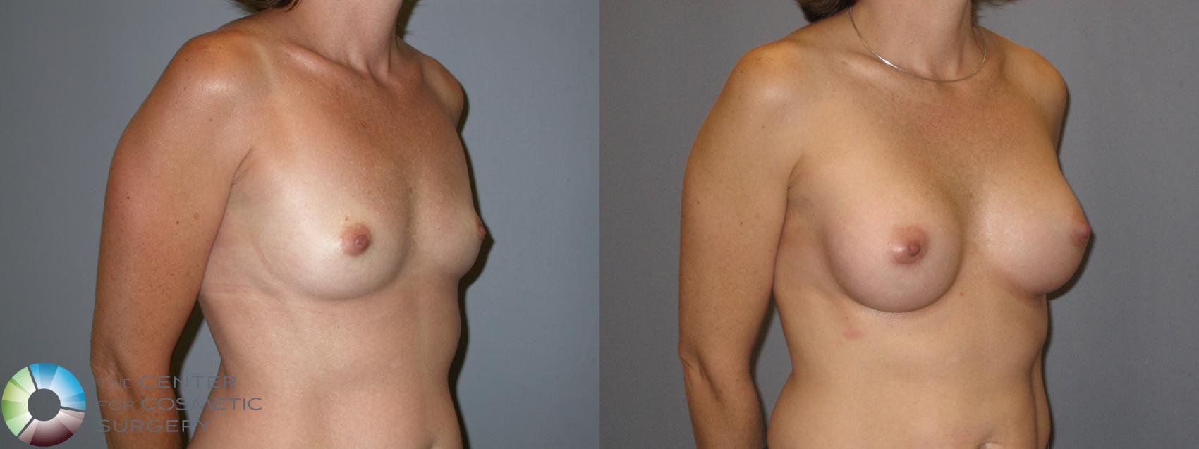 Before & After Breast Augmentation Case 122 View #4 View in Denver & Golden, CO