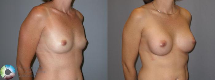 Before & After Breast Augmentation Case 122 View #4 in Denver and Colorado Springs, CO