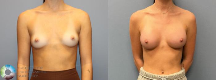 Before & After Breast Augmentation Case 12223 Front in Denver and Colorado Springs, CO