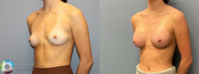 Before & After Breast Augmentation Case 12223 Left Oblique in Denver and Colorado Springs, CO