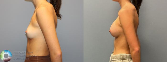 Before & After Breast Augmentation Case 12223 Left Side in Denver and Colorado Springs, CO