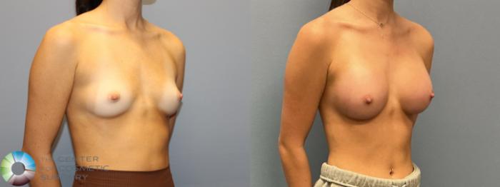 Before & After Breast Augmentation Case 12223 Right Oblique in Denver and Colorado Springs, CO