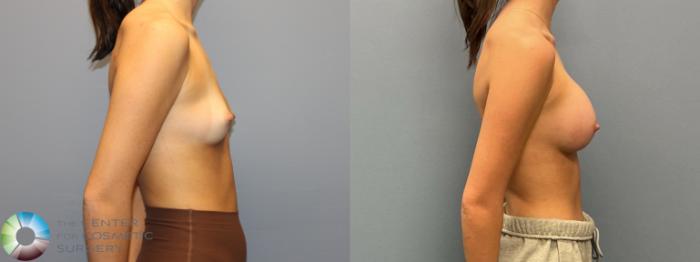 Before & After Breast Augmentation Case 12223 Right Side in Denver and Colorado Springs, CO