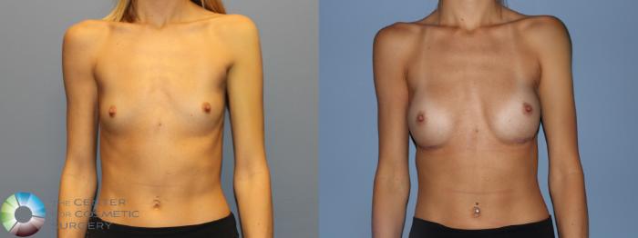 Before & After Breast Augmentation Case 12232 Front in Denver and Colorado Springs, CO