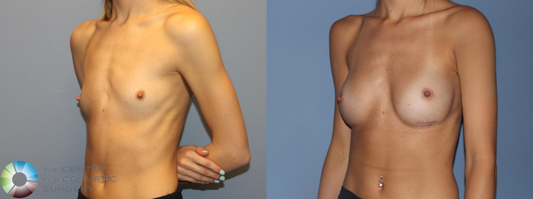 Before & After Breast Augmentation Case 12232 Left Side in Denver and Colorado Springs, CO