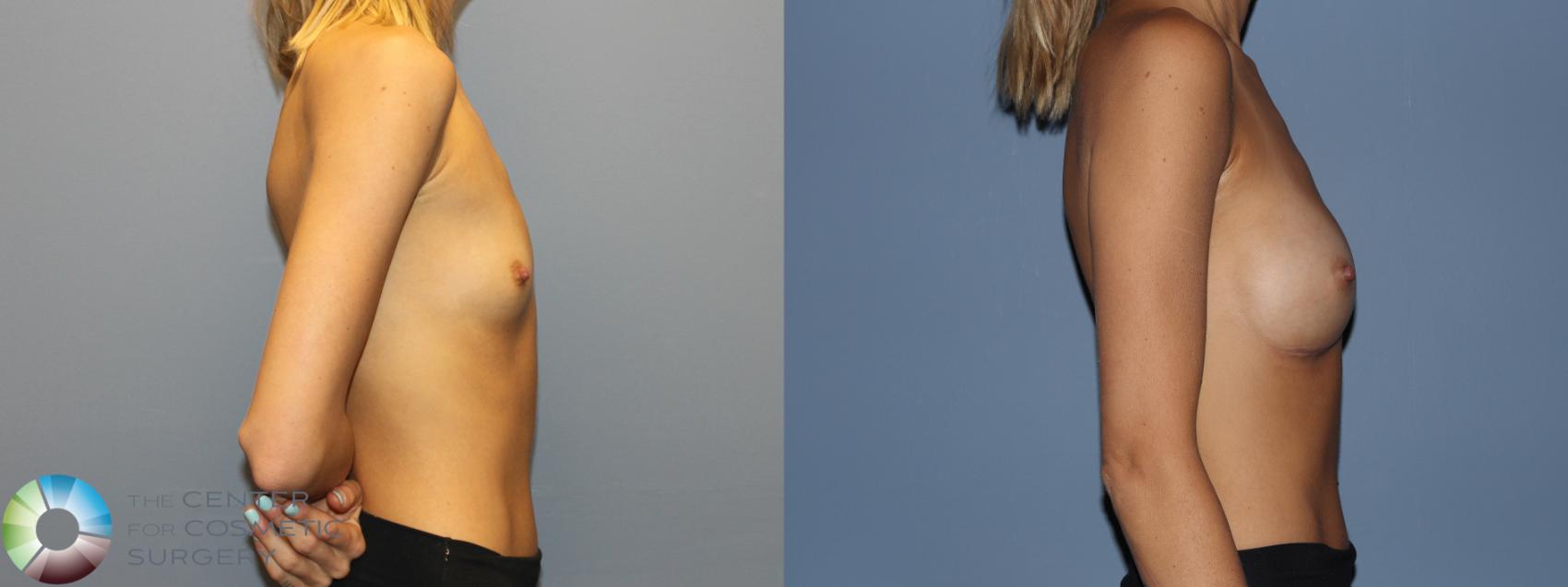 Before & After Breast Augmentation Case 12232 Right Side in Denver and Colorado Springs, CO