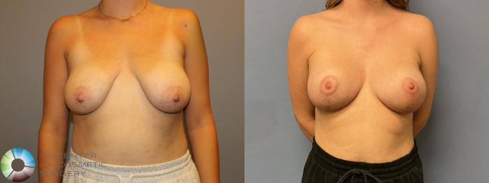 Before & After Breast Augmentation Case 12233 Front in Denver and Colorado Springs, CO