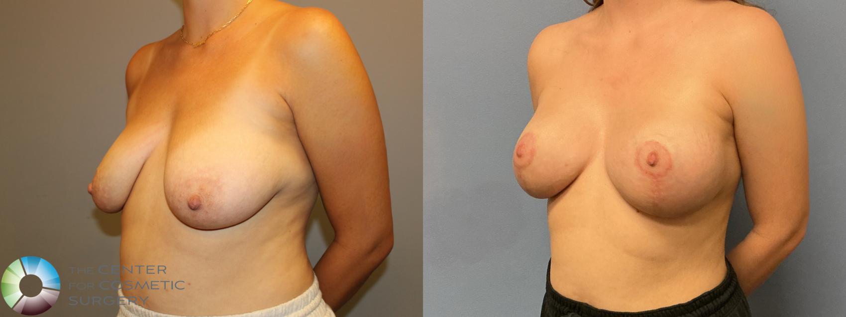 Before & After Breast Augmentation Case 12233 Left Oblique in Denver and Colorado Springs, CO