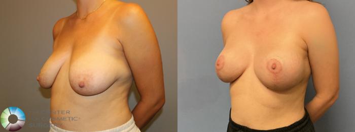 Before & After Breast Augmentation Case 12233 Left Oblique in Denver and Colorado Springs, CO