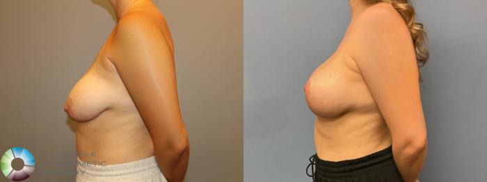Before & After Breast Augmentation Case 12233 Left Side in Denver and Colorado Springs, CO