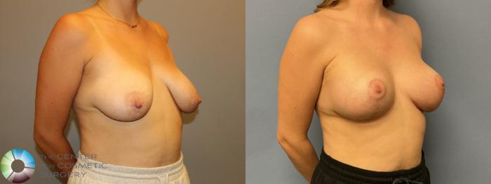 Before & After Breast Augmentation Case 12233 Right Oblique in Denver and Colorado Springs, CO