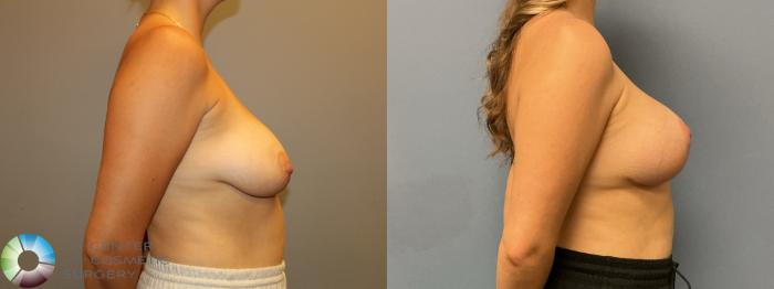 Before & After Breast Augmentation Case 12233 Right Side in Denver and Colorado Springs, CO