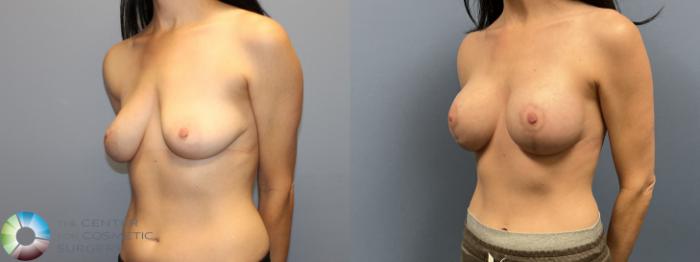 Before & After Breast Lift Case 12234 Left Oblique in Denver and Colorado Springs, CO