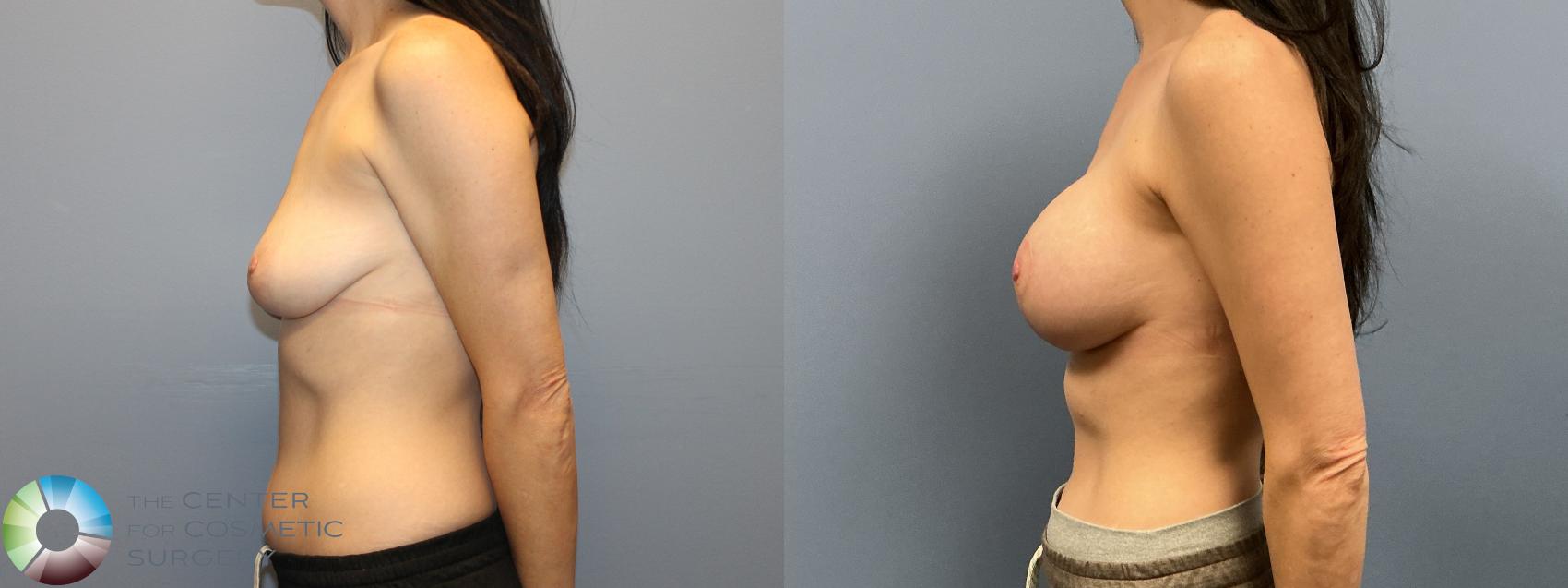 Before & After Breast Augmentation Case 12234 Left Side in Denver and Colorado Springs, CO