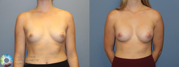 Before & After Breast Augmentation Case 12239 Front in Denver and Colorado Springs, CO