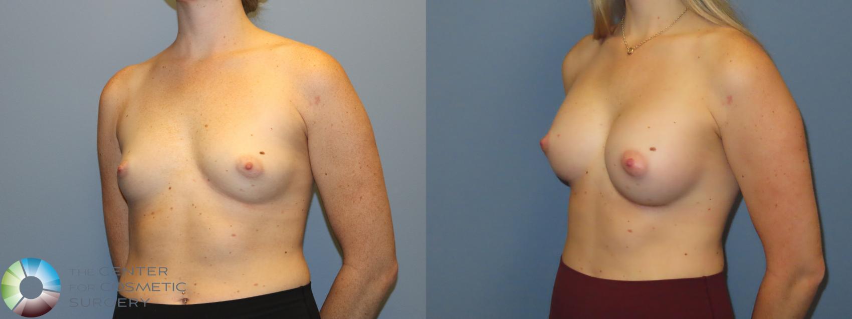 Before & After Breast Augmentation Case 12239 Left Oblique in Denver and Colorado Springs, CO