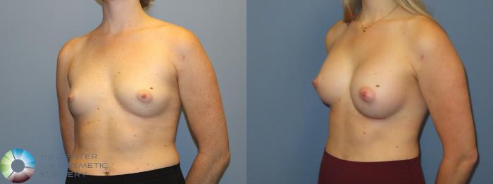Before & After Breast Augmentation Case 12239 Left Oblique in Denver and Colorado Springs, CO