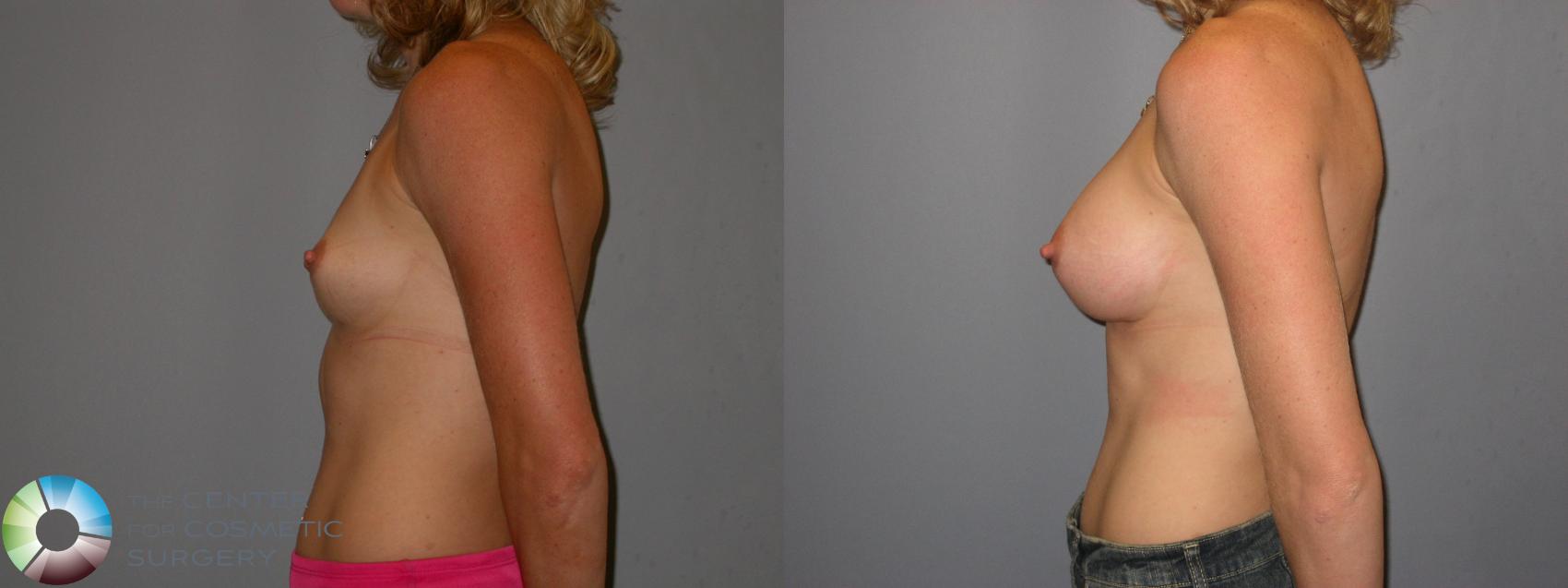 Before & After Breast Augmentation Case 123 View #2 View in Golden, CO